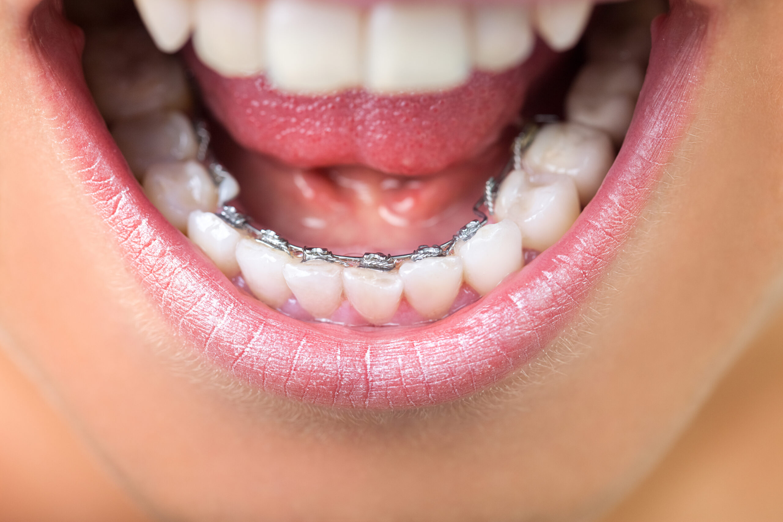 Nahaufnahme von einer lingualen Zahnspange